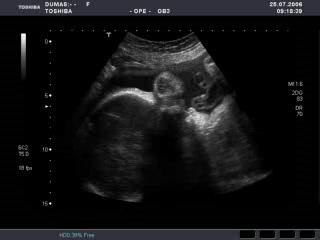 sarah à 30 semaines de grossesse