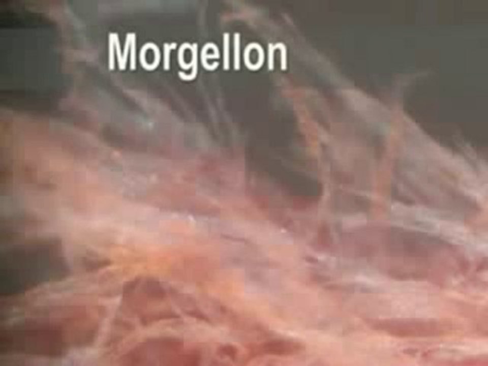 Interview Hildegarde staninger Morgellons, chemtrails 1sur7