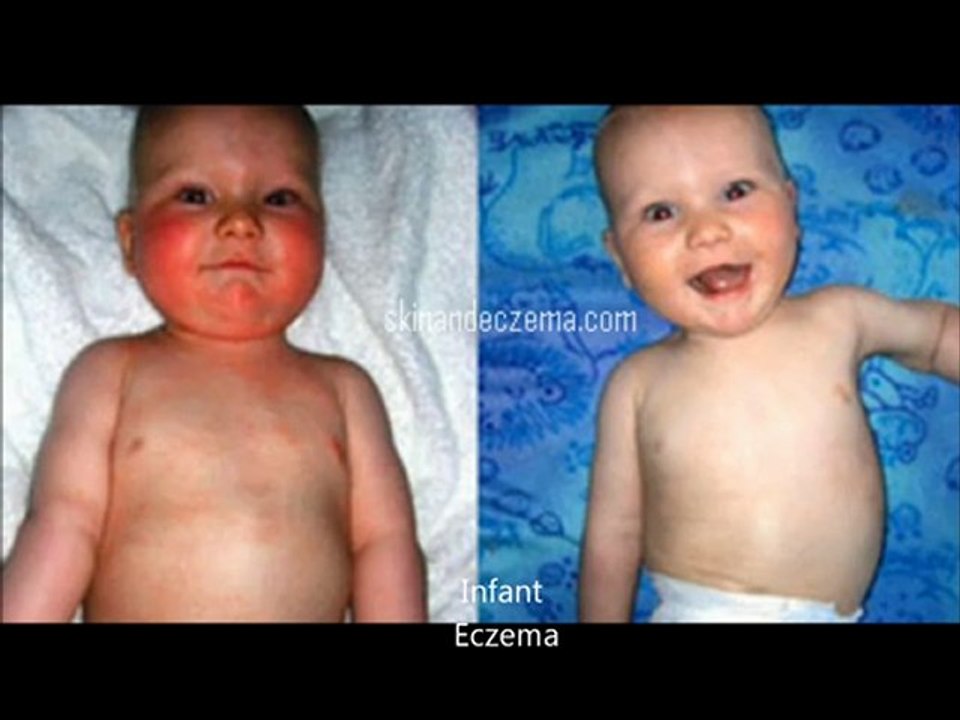 Eczema Video