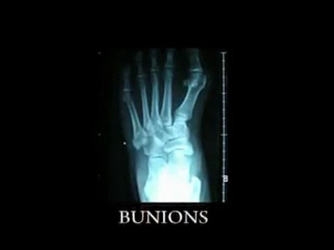 Foot Pain and Bunions - Family Foot and Leg Center/ Naples Podiatrist