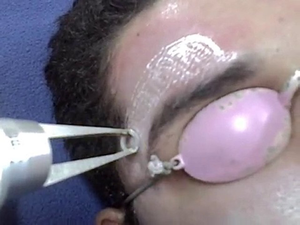 secuelas de acne