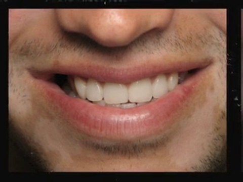 Beverly Hills Porcelain Veneers Dentist