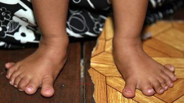 Une fillette avec 14 orteils !