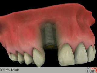 Dental Implant versus Dental Bridge – Which Is More Reliable