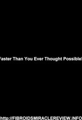 Fibroids Treatment
