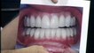 Odessa Porcelain Dental Veneers under Sedation - Robin Ruthe