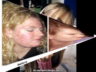 Get rid of acne fast