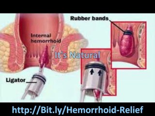 get rid of hemorrhoids
