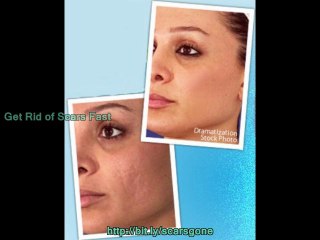 How to Remove Scars Quickly