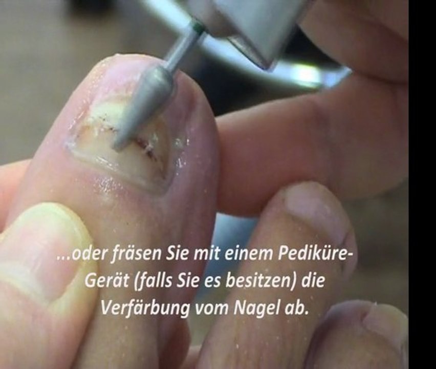 Alle durch nagelpilz schäden an ihrem zehennagel in 15 min. mit dem fußnagel spray weg! 0,50€ pro woche!