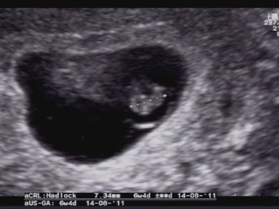 aborto ritenuto