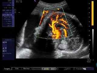 Medicina prenatal: Ecografia (Eduard Gratacos)