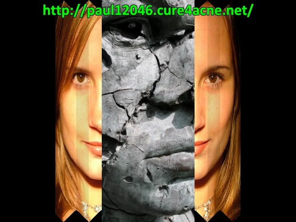 acne medication