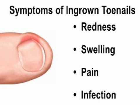Ingrown Toenails - Podiatrist in Myrtle Beach, Conway, Littl