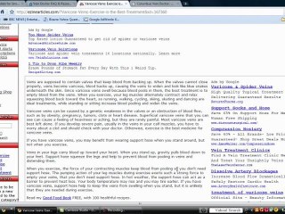 Varicose Vein Doctor Consultations and Information