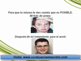 Encuentran la Cura Para el Acne