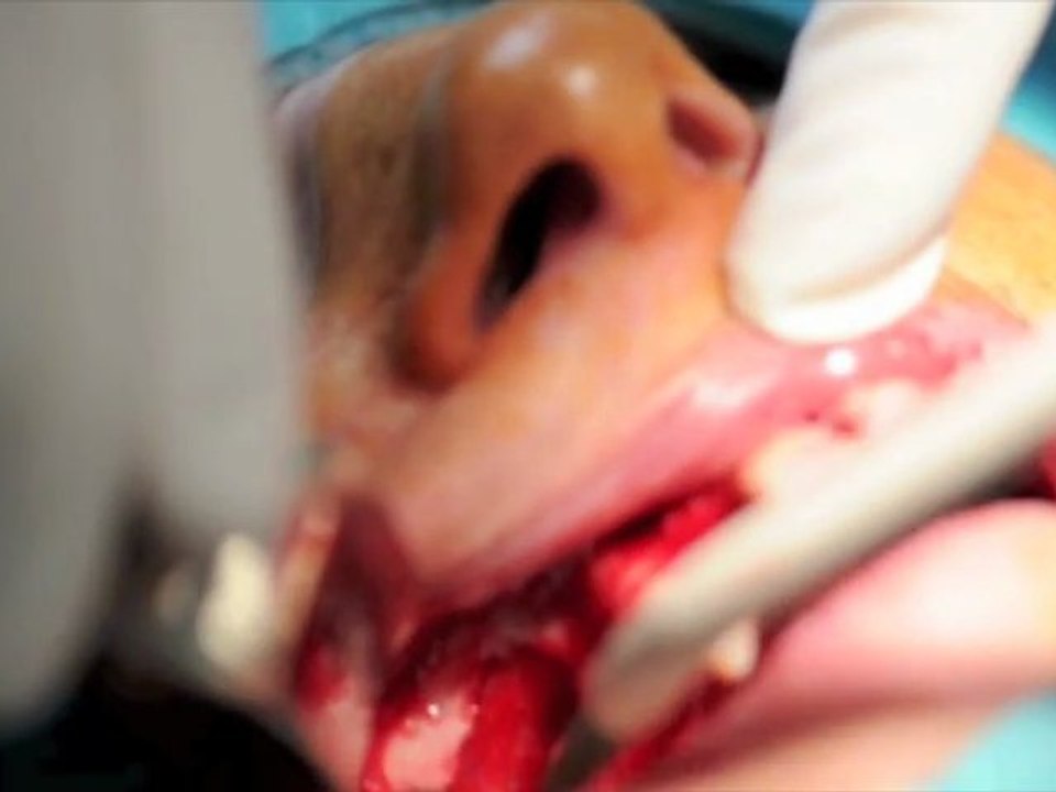 SINUS MEMBRANE DETACHMENT Dr TAMMAM Ruben
