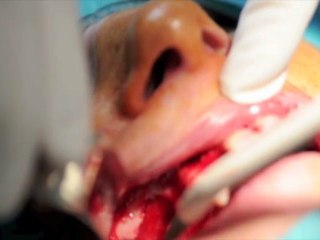 SINUS MEMBRANE DETACHMENT Dr TAMMAM Ruben