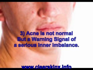 what causes acne