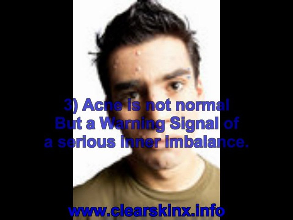 acne help