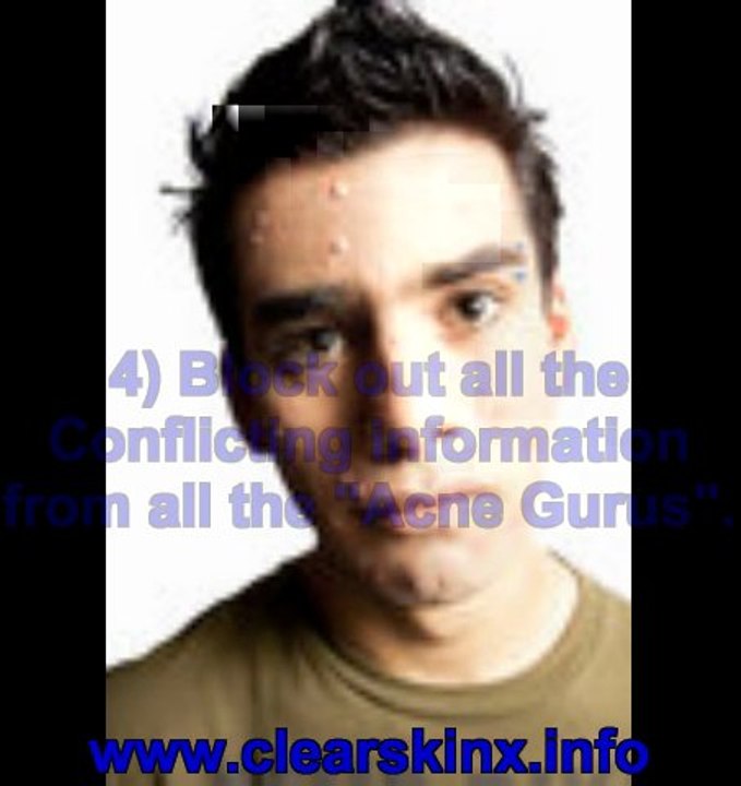 best acne cure