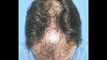 Hair transplant by Dr Wong - 4000 Grafts - 1 Session