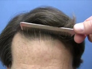 Best Hair Transplant Doctor - 5880 Grafts - Dr Hasson
