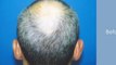 Hair Transplant Before After - Dr Hasson - 5488 Grafts