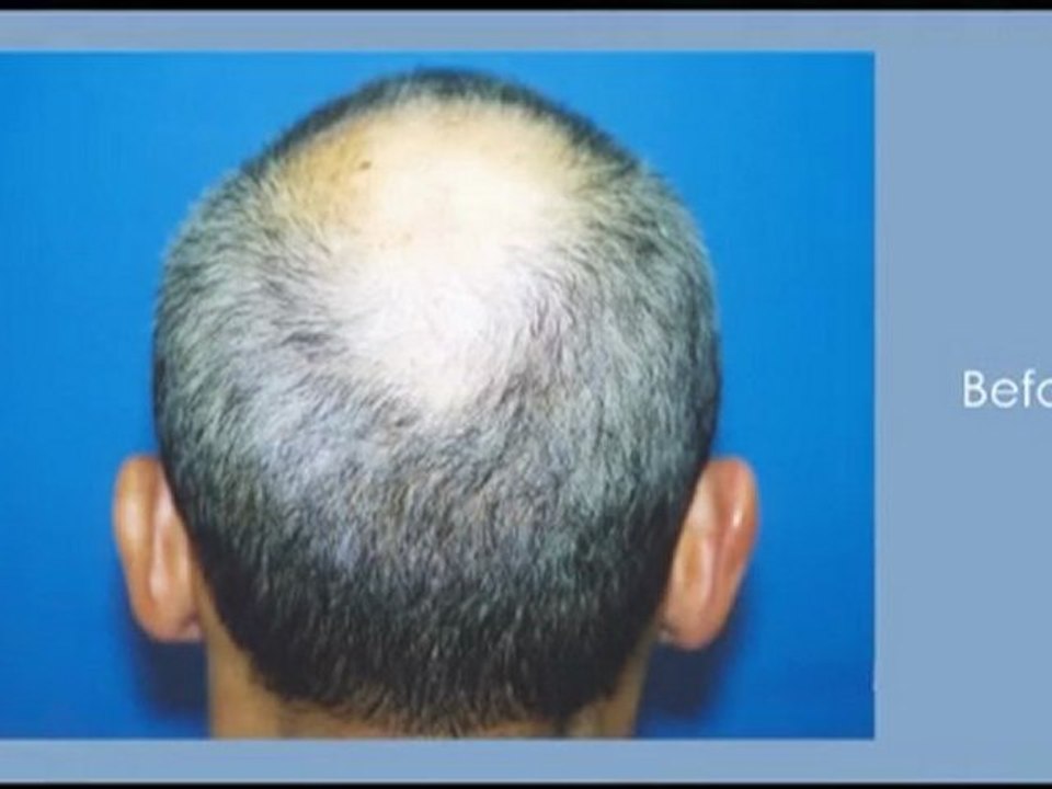 Hair Transplant Before After - Dr Hasson - 5488 Grafts