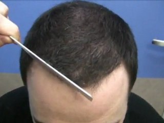 Hair Restoration Video - 7781 Grafts - Dr Hasson