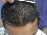 Celebrity Hair Transplant Clinic - Dr Hasson - 2750 Grafts