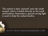 Denver Dental Implant dr. discusses dental sealants