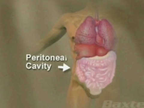 Peritoneal Dialysis _ Kidney Disease