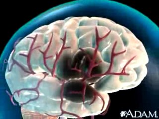 Ictus: Accidente cerebrovascular (ACV)