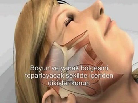 Yüz Germe Face Lifting Ameliyatı Ekipestetik.com