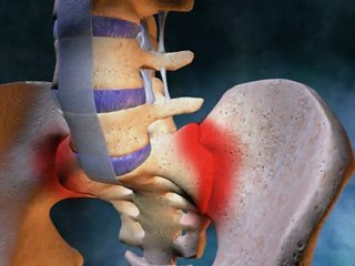 What Is Ankylosing Spondylitis? | Chiropractor Atlanta