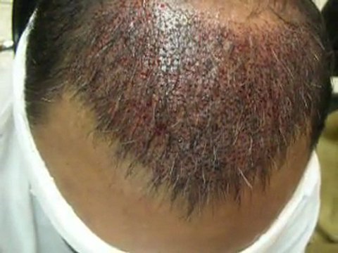 FUE hair Transplantation 1937 grafts in Pakistan/single session by Dr.Ahmad Chaudhry
