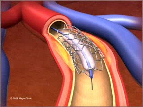 Percutaneous coronary Intervention stenting