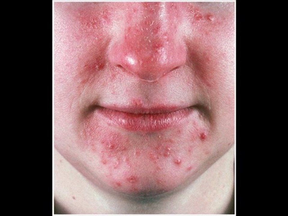 Rosacea Treatments - What Works & What Doesn't