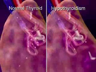 Effects of Thyroid Disease