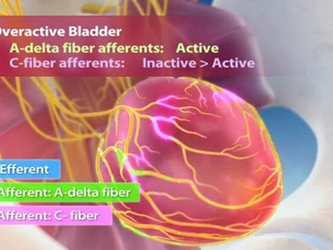 Overactive Bladder Disorder (OAB) animation