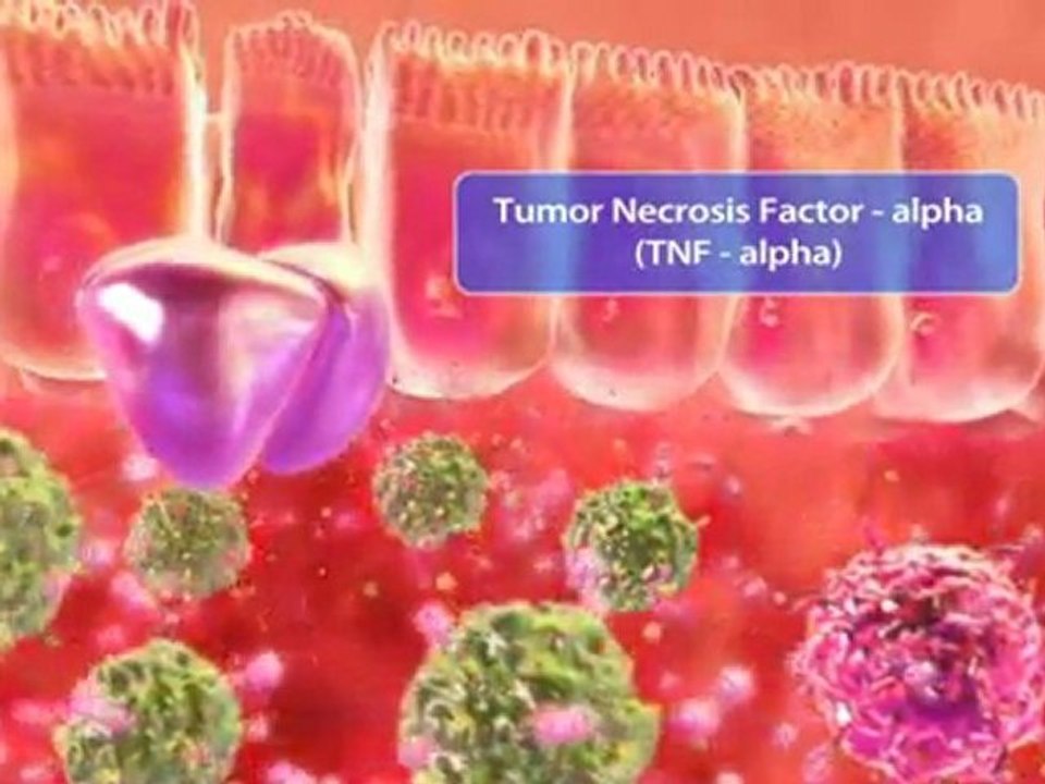 Crohns disease shown in photorealistic animation