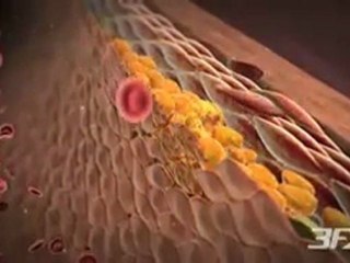 Diabetic Peripheral Arterial Disease (P.A.D.)