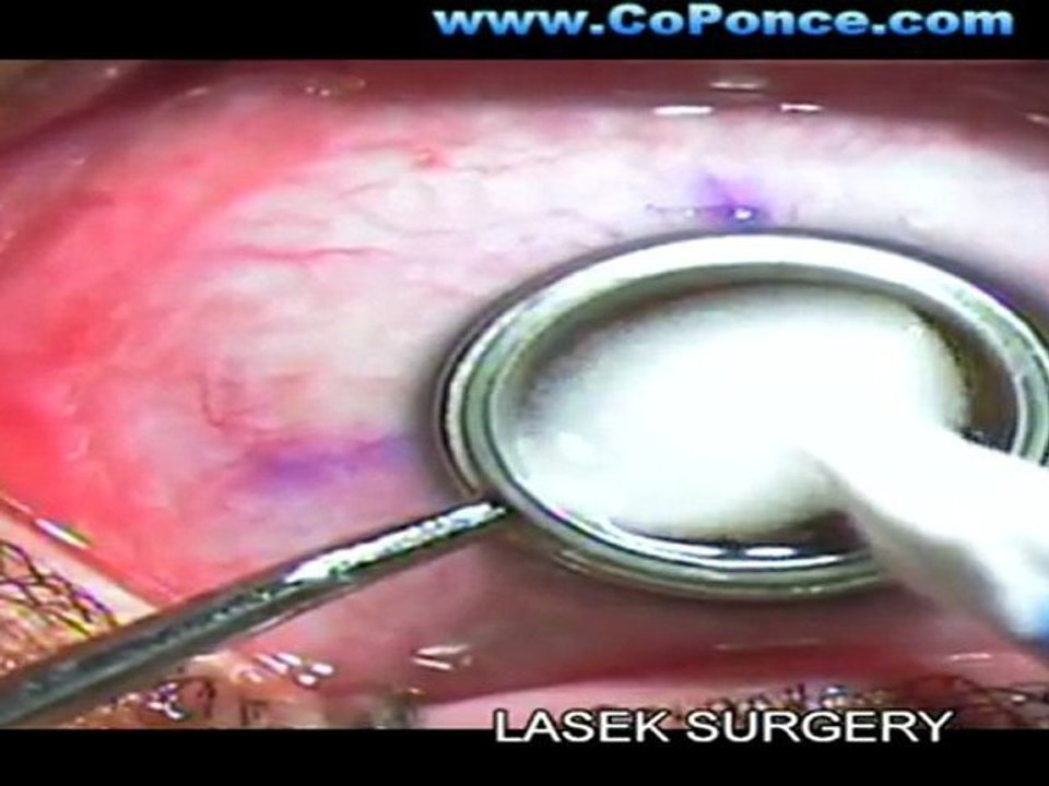 Ecuador Excimer Laser surgery - Dr PONCE