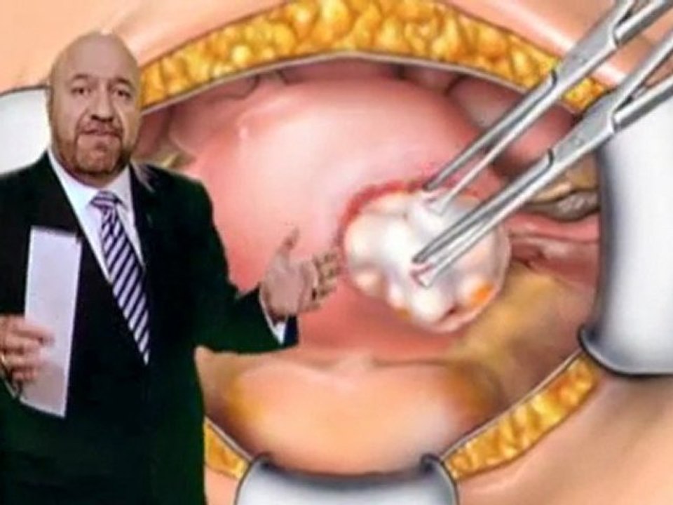 Fibroids