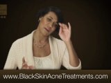 Acne Treatments for African Americans - RX for Brown Skin
