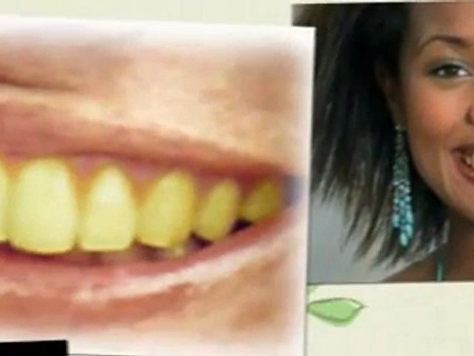 Idol White - Teeth Whitening Pens