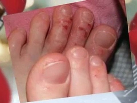 Zetaclear - Nail Fungus Killer