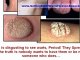 remove skin tags yourself, best wart remover, skin tag removal home remedy, skin tag removal at home , how to remove skin tags, how to get rid of skin tags, skin tags how to remove , skin tag remover, how to get rid of a wart