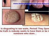 treatment of warts - home remedies for warts - how to remove skin tags yourself
